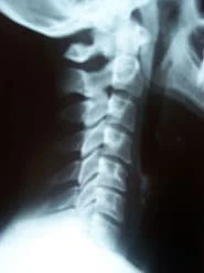 Chiropractic Oneida NY X Ray